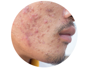 Deep nodulocystic lesions