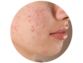 Inflammatory papules and pustules