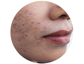 Non-inflammatory comedones